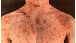 Armidale measles case confirmed 