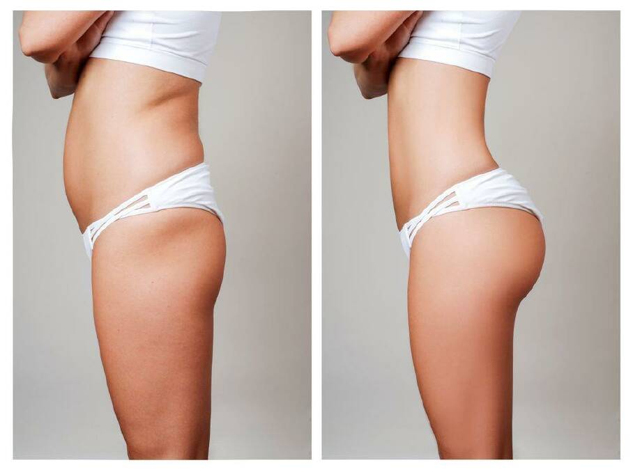 Tips on how to prepare for your liposuction procedure