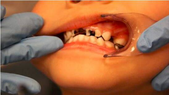 Family Matters || Why our kids have a high rate of dental decay